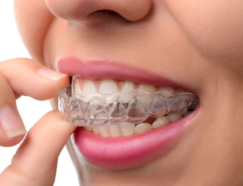 Here are 6 Reasons NOT to use Mail-Order Dental Aligner Services